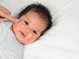 Dermatitis Atopik Pada Bayi: Kenali Penyebab dan Perawatannya