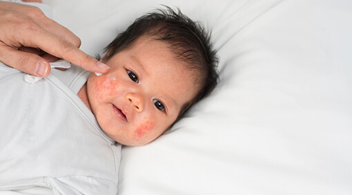 Dermatitis Atopik Pada Bayi: Kenali Penyebab dan Perawatannya