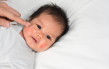 Dermatitis Atopik Pada Bayi: Kenali Penyebab dan Perawatannya