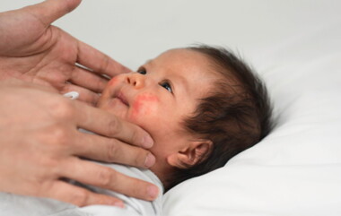 Penyebab Kulit Bayi Merah dan Cara Mengatasinya     