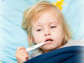 Penyebab Virus Campak dan Pencegahannya