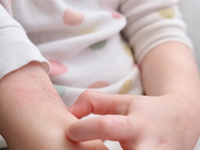 Mengenal Psoriasis pada Anak dan Penanganannya 