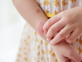 Alergi Makanan pada si Kecil: Gejala, Penyebab, dan Cara Mengatasinya  