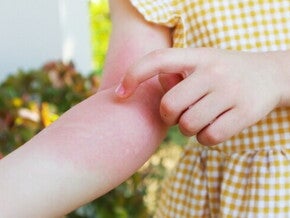Kenali Penyebab Biduran pada Anak dan Cara Mengatasinya.jpg Kenali Penyebab Biduran pada Anak dan Cara Mengatasinya.jpg