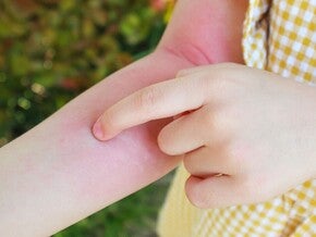Ciri-Ciri Anak Alergi Susu Sapi: Gejala, Penyebab, dan Cara Mengatasinya