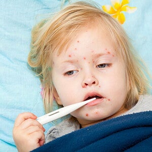 Penyebab Virus Campak dan Pencegahannya Penyebab Virus Campak dan Pencegahannya