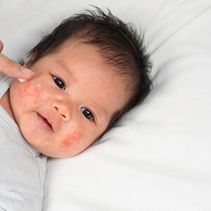 Dermatitis Atopik Pada Bayi: Kenali Penyebab dan Perawatannya