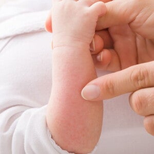 Cara Mencegah Alergi Pada Bayi dengan Tepat (1).jpg