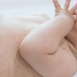 Jenis Biang Keringat pada Bayi Jenis Biang Keringat pada Bayi