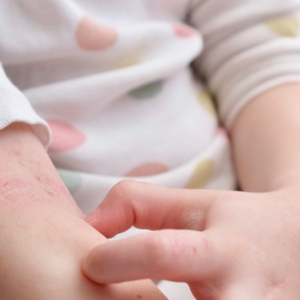 Mengenal Psoriasis pada Anak dan Penanganannya 
