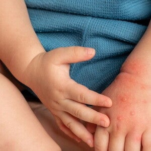 kulit bayi bruntusan