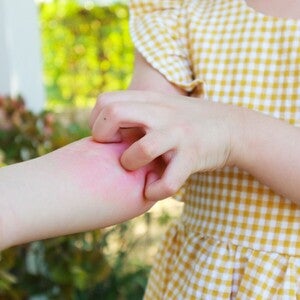 Mam, Catat 10 Penyakit Kulit pada Anak yang Sering Terjadi, Berikut Ini!