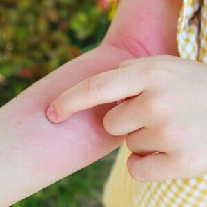 Ciri-Ciri Anak Alergi Susu Sapi: Gejala, Penyebab, dan Cara Mengatasinya