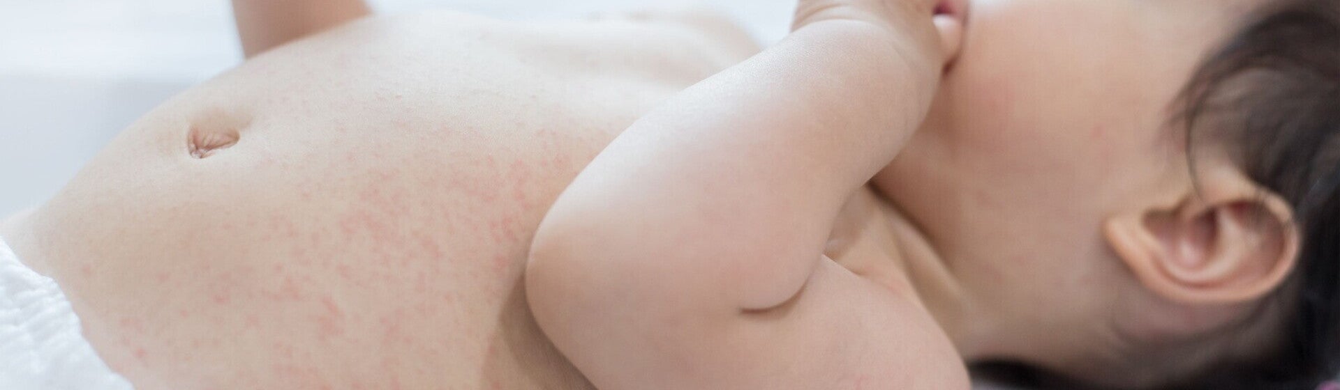 Jenis Biang Keringat pada Bayi Jenis Biang Keringat pada Bayi