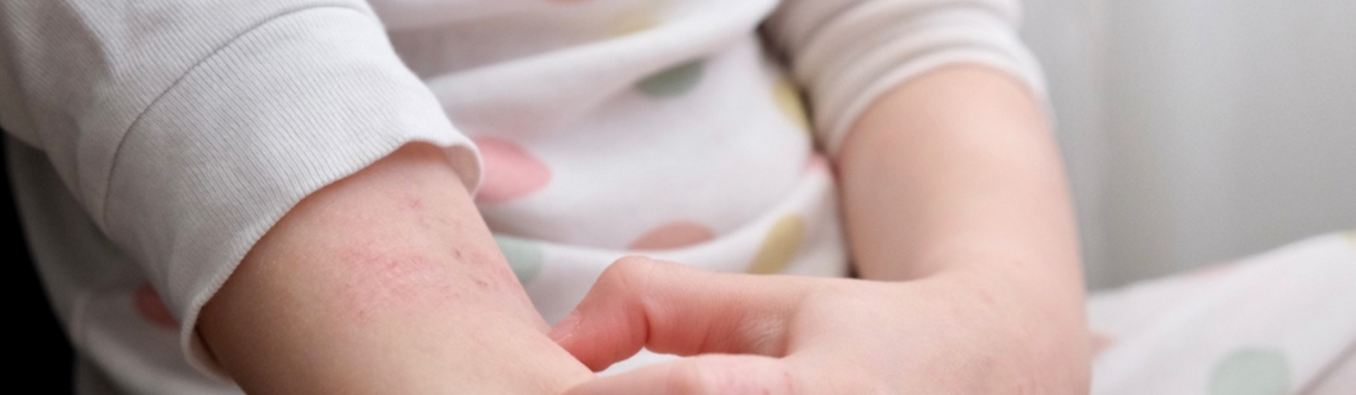 Mengenal Psoriasis pada Anak dan Penanganannya