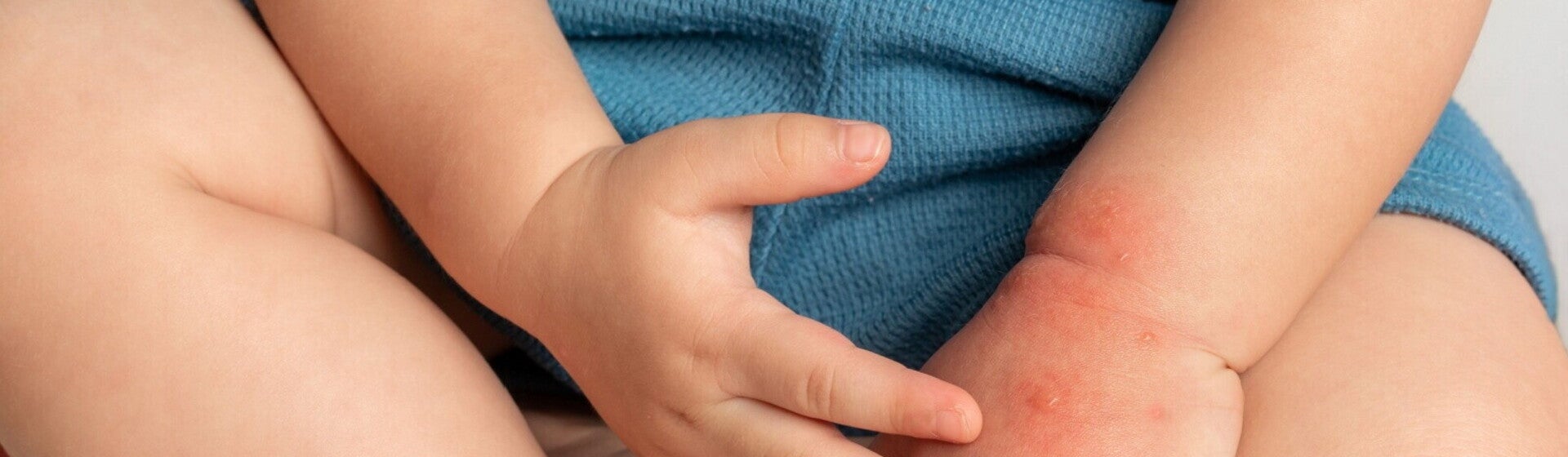 Kulit Bayi Bruntusan Kulit Bayi Bruntusan