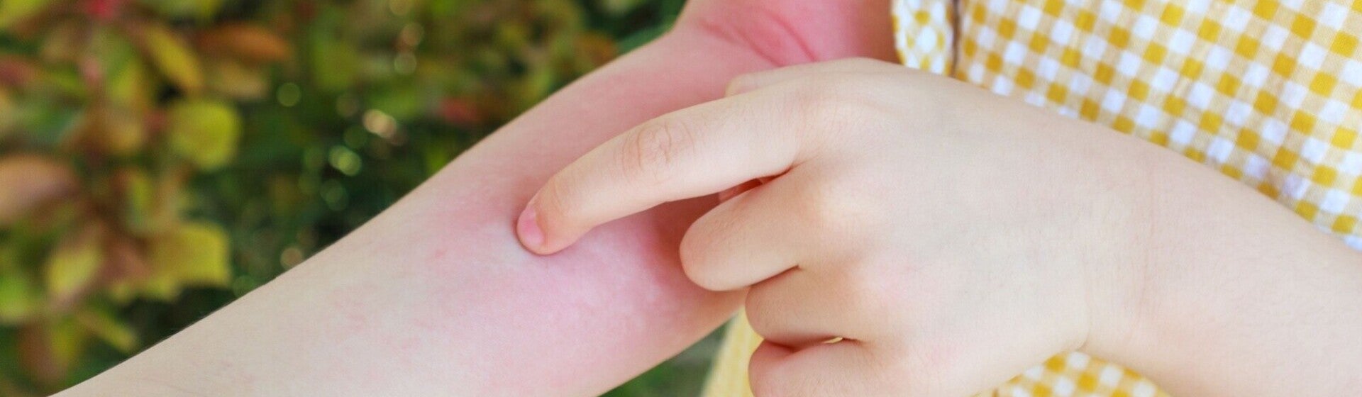 Ciri-Ciri Anak Alergi Susu Sapi: Gejala, Penyebab, dan Cara Mengatasinya