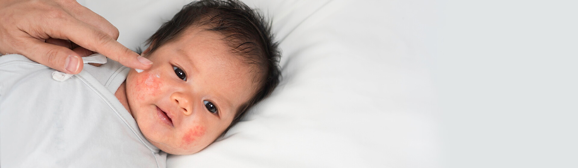 Dermatitis Atopik Pada Bayi_ Kenali Penyebab dan Perawatannya_.jpg Dermatitis Atopik Pada Bayi_ Kenali Penyebab dan Perawatannya_.jpg