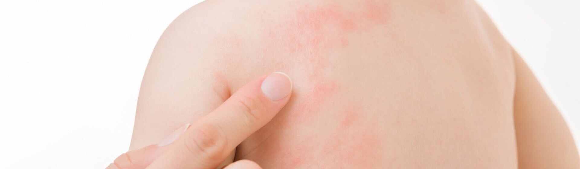 Kenali Penyebab Alergi Susu Formula pada Bayi Ini! Kenali Penyebab Alergi Susu Formula pada Bayi Ini!